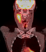 Tongue cancer, PET CT scan