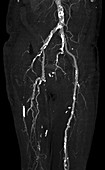 Abdominal aorta, calcification, CT angiography