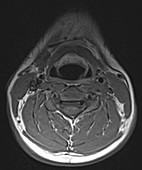 Normal neck and cervical spine, MRI