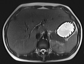 Normal abdomen, lumbar spine, sacrum, MRI