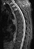 Bone marrow edema, MRI