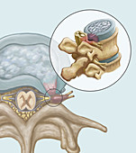Herniated Disk, illustration