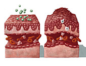 Allergy Reaction on Skin, illustration