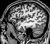 Normal Sagittal T1 MRI Brain 2