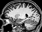 Normal Sagittal T1 MRI Brain 6