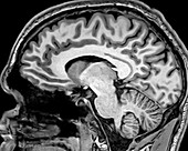 Normal Sagittal T1 MRI Brain 8