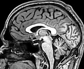 Normal Sagittal T1 MRI Brain 10