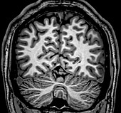 Normal Coronal T1 Brain