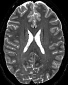 Normal Axial T2 Brain
