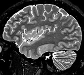 Normal Sagittal T2 Brain 3 0f 11