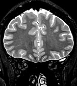 Normal Coronal T2 Brain