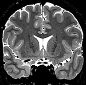 Normal Coronal T2 Brain