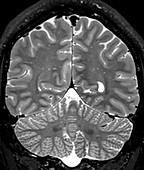 Normal Coronal T2 Brain