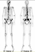 Metastatic renal cell carcinoma, bone scan