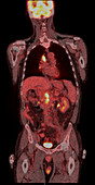 Metastatic renal carcinoma, CT scan
