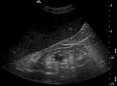 Chronic renal failure, Ultrasound