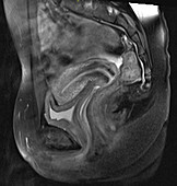 Normal female pelvis, MRI