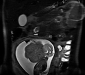 Foetus, 18 weeks, MRI