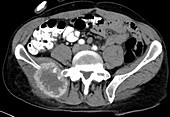 Metastatic renal carcinoma, pelvis, CT scan