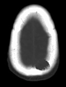 Metastatic renal cell carcinoma to skull, CT scan