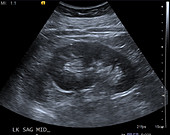 Normal kidney, ultrasound