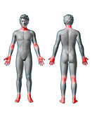 Atopic Dermatitis Locations, illustration