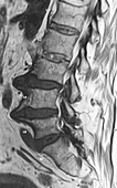 Large Bone Spurs Lumbar Spine, MRI