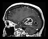 Glioblastoma, MRI