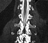Conus Medullaris on CT Myelogram