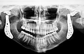 Panorex X-Ray of Maxillofacial Region