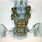 Spinal Instrumentation from 3D CT Scan