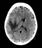 Glioblastoma Temporal Lobe, CT Scan