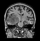 Glioblastoma Temporal Lobe, MRI