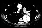 Aortic Dissection, CTA