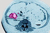 Colon cancer, CT colonoscopy