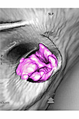 Colon cancer, 3D CT Colonoscopy