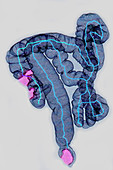 colorectal cancer, 3D CT scan