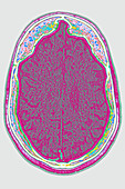 Alzheimer's disease, CT scan