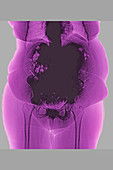 Obesity, X-ray