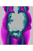 Obesity, X-ray