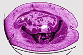 Obesity, CT scan