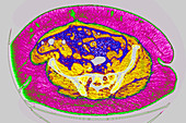 Obesity, CT scan