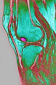 Edema of the knee, MRI