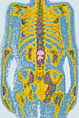 Osteoporosis of lumbar vertebrae, body scintigram