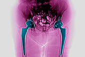 Total hip prostheses, X-ray