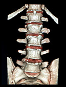 Reconstruction of Lumbar Spine, 3D CT