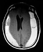 Chronic Bilateral Subdural Hematomas, MRI