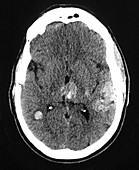 Cavernous Malformations of the Head, CT Scan