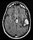 Cavernous Malformations of the Head, MRI