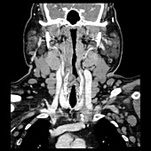 Neck with Chronic Lymphocytic Leukaemia (CLL), CT